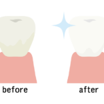 歯のホワイトニングのビフォーアフターのイラスト