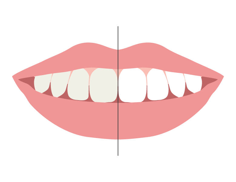 歯のホワイトニングのイラスト